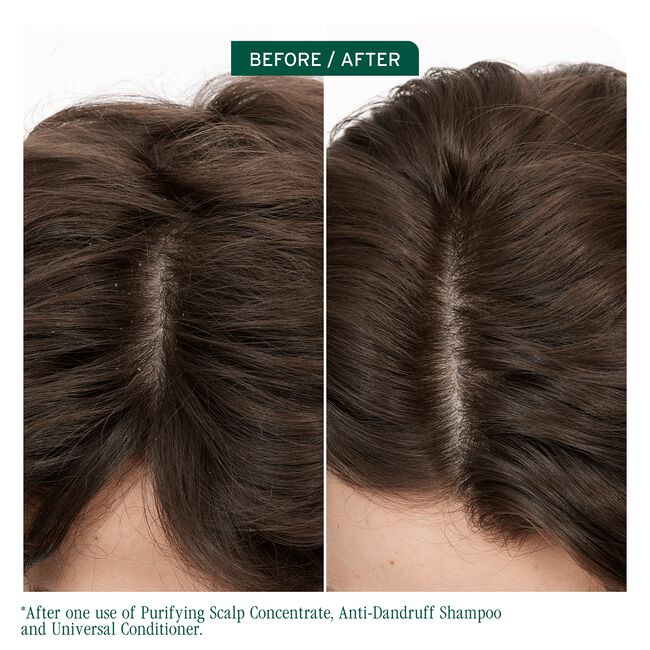 Before and after comparison of scalp and hair with text indicating product use.